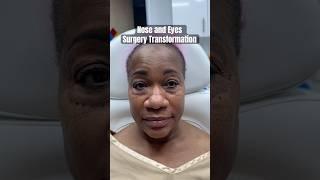 African American Nose Job and Eyelid Surgery  Beautiful Plastic Surgery Results