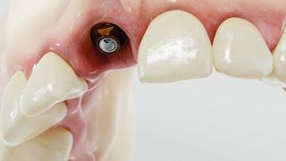 Precision Dentistry with DeSR Abutment