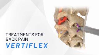 The Vertiflex Procedure - Treatments for Back Pain