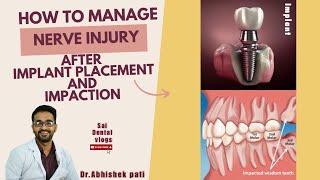 HOW TO MANAGE NERVE INJURY AFTER PLACING IMPLANTS