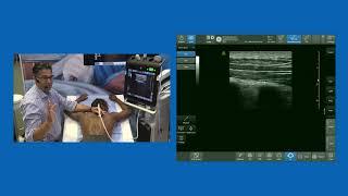 Erector Spine Plane (ESP) block - Live Demo