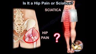 Is It Hip Pain or Sciatica?  which one is causing the pain , how do  I know and how to treat it ?