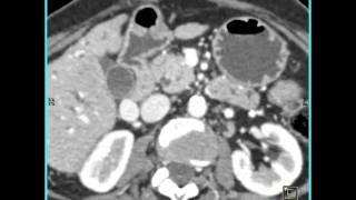 Abdomen: Pancreas: Staging of pancreatic cancer:Analysis of arterial and venous structures(5 of 11)