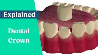 Dental Crown Procedure Explained