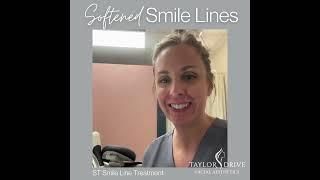 Soften Your Smile Lines Without Surgery or Fillers