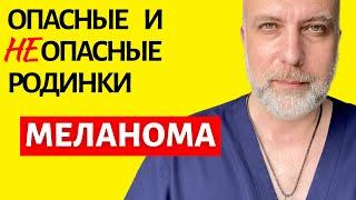 Когда ваши родинки опасны? Что такое меланома кожи и как самостоятельно обнаружить ее у себя