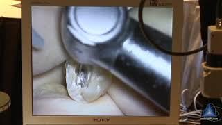 3 Rooted Maxillary Bicuspid: Preflaring for Successful Negotiation: Advanced Endodontics