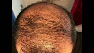 10 months using minoxidil - Rogaine 5% Before & After results