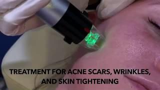 Genius Lift RF MicroNeedling Treatment at Z Center for Cosmetic Health