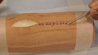 Suture Removal - simple interrupted