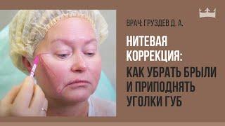 Нитевая коррекция: как убрать брыли и приподнять уголки губ