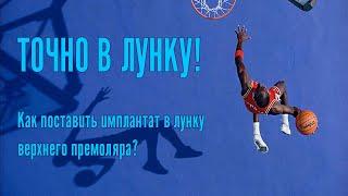 Как одномоментно установить имплантат в лунку верхнего премоляра? Подробный видео-разбор