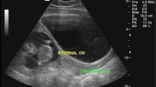 Ultrasound Of cervix External and internal OS