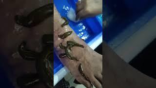 varicose vein leech therapy