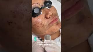 Carbon laser peel