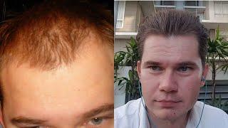 How To Regrow Hair Without Transplant