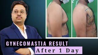 Gynecomastia Result From Assam || Man Boob Reduction  || Dr. Jayant Bain Plastic Surgeon