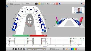 How to Analyze Bite Timing with T-Scan