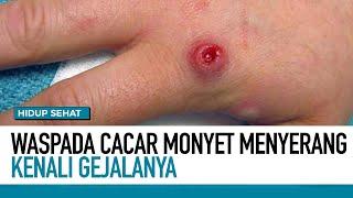 Waspada Cacar Monyet Menyerang! Kenali Gejalanya | Hidup Sehat