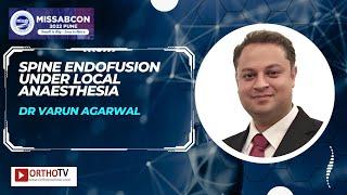 Spine Endofusion under Local Anaesthesia - Dr Varun Agarwal