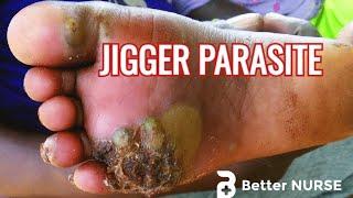 JIGGER PARASITE