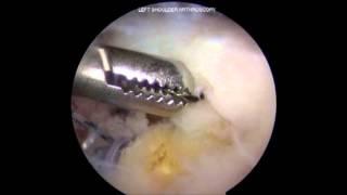 Arthroscopic Rotator Cuff Repair - Dr. David Wang