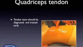 Quadriceps Tendon Tear