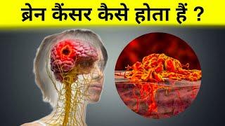 ब्रेन कैंसर कैसे होता है ? -  brain tumor science