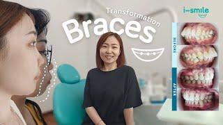 “I can finally smile”  Miss A W ! Life changing Braces #1
