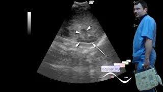 Neonatal renal ultrasound - Normal adrenal gland of a newborn