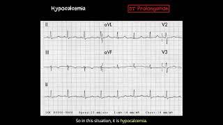 Recognizing Hypocalcemia: ECG Changes & Key Indicators