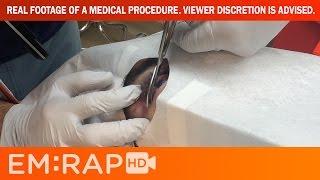 How to do a lateral canthotomy