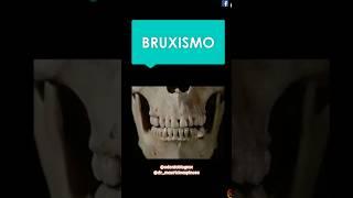 Bruxismo #shorts #bruxismo #bruxismodiurno #bruxismonocturno #apretandodientes #odontologia