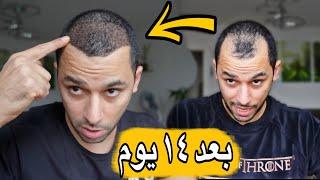 How much i paid for my HAIR TRANSPLANT - Is it NECESSARY ? دفعت كام في زراعة شعري في تركيا