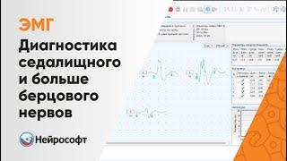 ЭМГ: Диагностика Повреждений Седалищного и Большеберцового Нервов