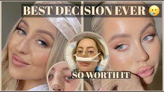 NOSE JOB VLOG.. My entire Rhinoplasty recovery + results *the BEST Sydney surgeon*
