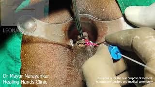 Proctologist Surgeon Mayur live from OT in Latur | Laser Sphincterotomy for Fissures & Piles surgery
