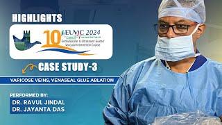 Varicose Veins, Venaseal Glue Ablation | 10th EUVIC 2024 | Dr Ravul Jindal | Dr Jayanta Das