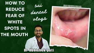 HOW TO REDUCE FEAR OF WHITE SPOTS IN THE MOUTH