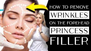 How to remove wrinkles on the forehead (contour plastic) Princess Filler
