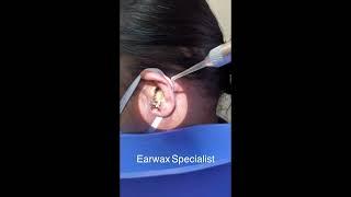 Removing Massive Earwax From Woman's Ear