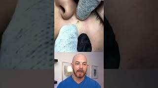 Derm reacts to MASSIVE pimple! #dermreacts #doctorreacts #pimplepop #pores