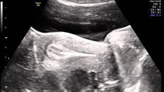 Ultrasound guided Embryo transfer