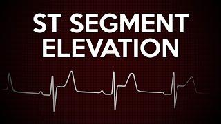 ST Segment Elevation: Simple ECG Explanation