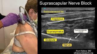 Ultrasound Guided Suprascapular Nerve Block (out of plane approach)