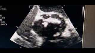 Aortic Root Abscess