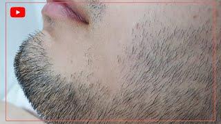 men beard hair removal waxing