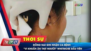 Đồng Nai ghi nhận ca bệnh "vi khuẩn ăn thịt người" Whitmore đầu tiên| Cần Thơ TV