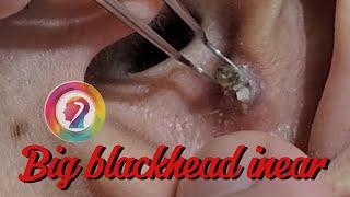 BIGGEST BLACKHEADS REMOVAL EVER - Extreme Blackheads in ear.