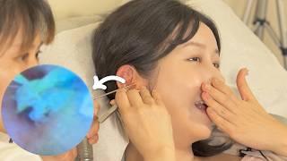 ASMRAmazing Endoscopic Ear Cleaning | Cat Hair in the Ear? | Shanghai, China Travel